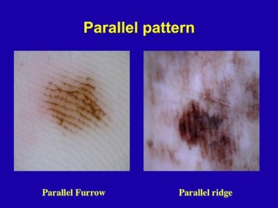 2018-Parallel-ridge-pattern