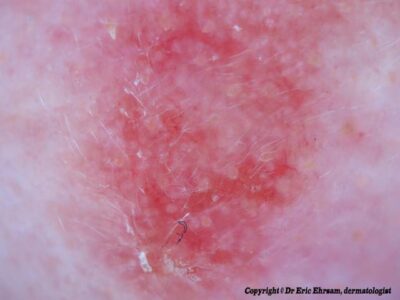 2015-Strawberry-pattern-actinic-keratosis