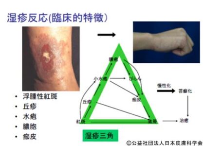 2014-EczemaTriangle