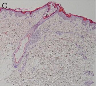 2012-keratosis-follicularis-squamosa-2