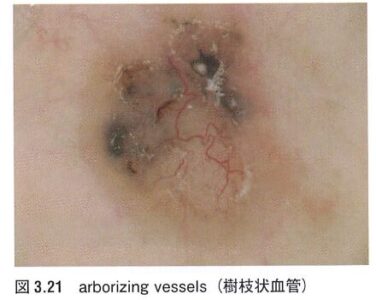 120-arborizingvessels